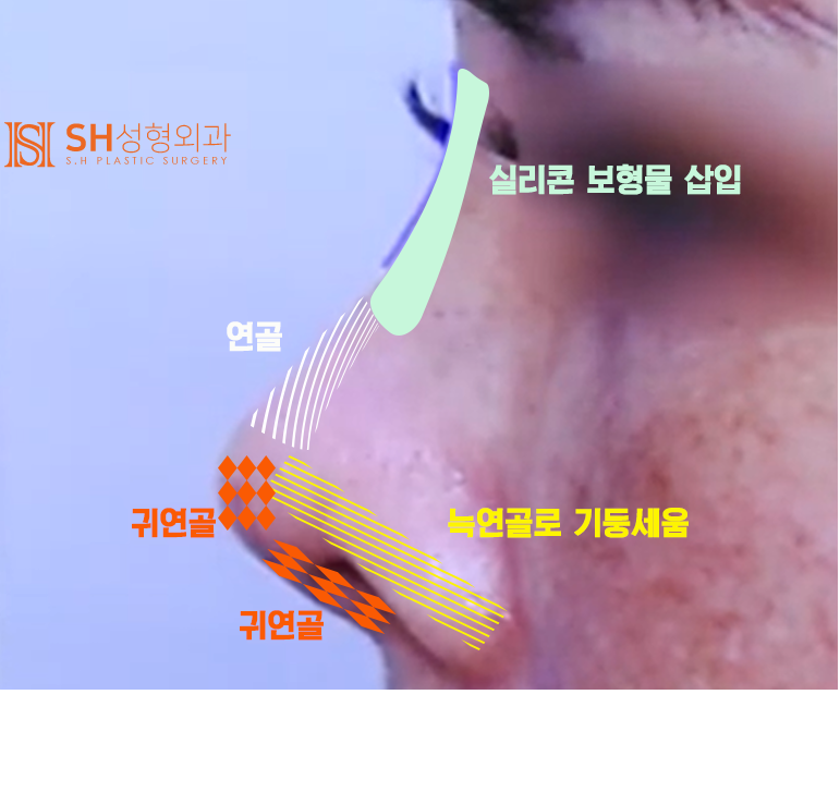 #20 Operasi Hidung Kontraktur: Bisakah Hidung yang Rusak Dipulihkan Kembali? 사진 7