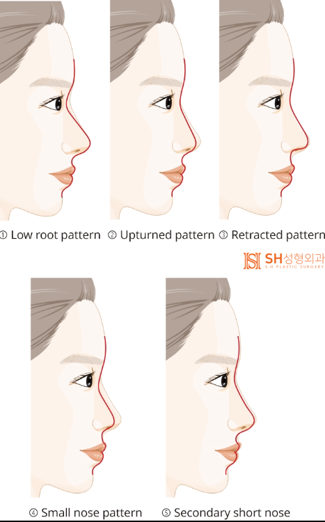 #20 Contracted Nose Revision Surgery: Can a Collapsed Nose Be Restored? 사진 5