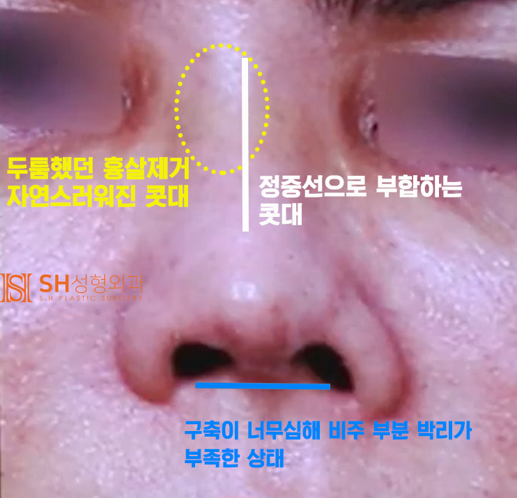 #20 Contracted Nose Revision Surgery: Can a Collapsed Nose Be Restored? 사진 8