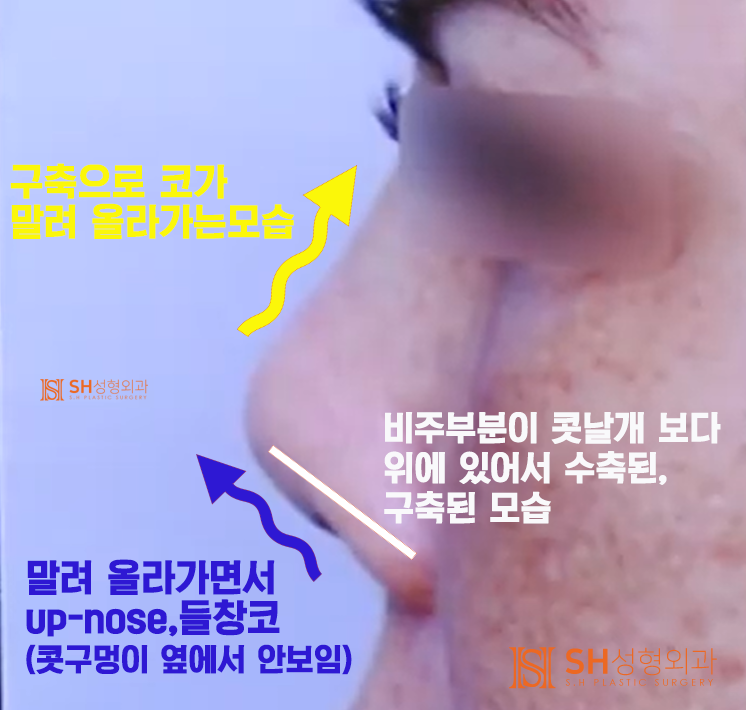 #20 Contracted Nose Revision Surgery: Can a Collapsed Nose Be Restored? 사진 4