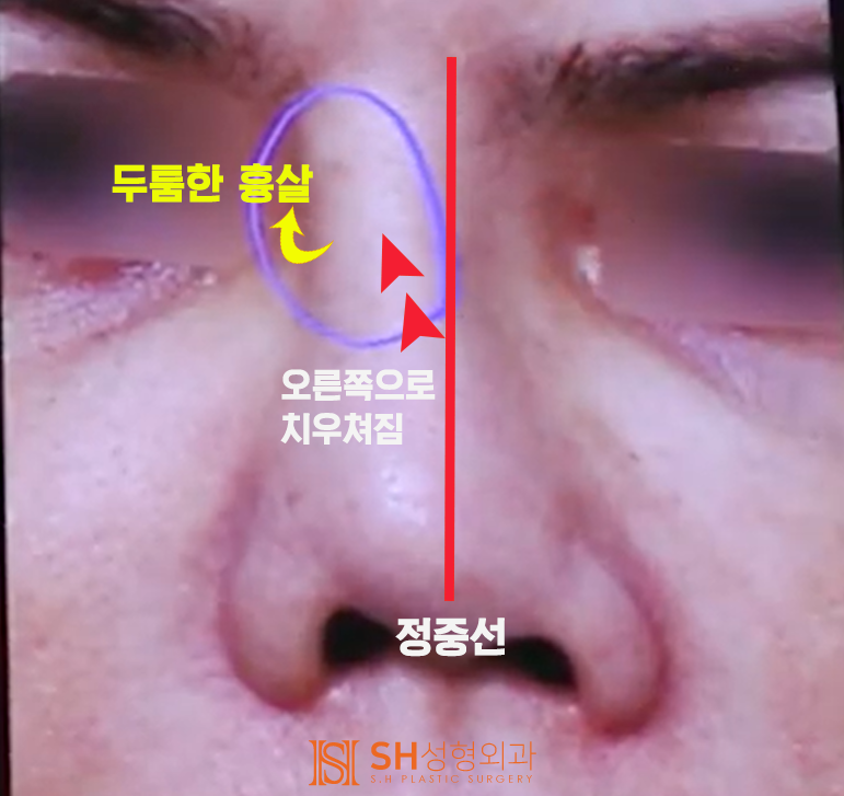 #20 Contracted Nose Revision Surgery: Can a Collapsed Nose Be Restored? 사진 2