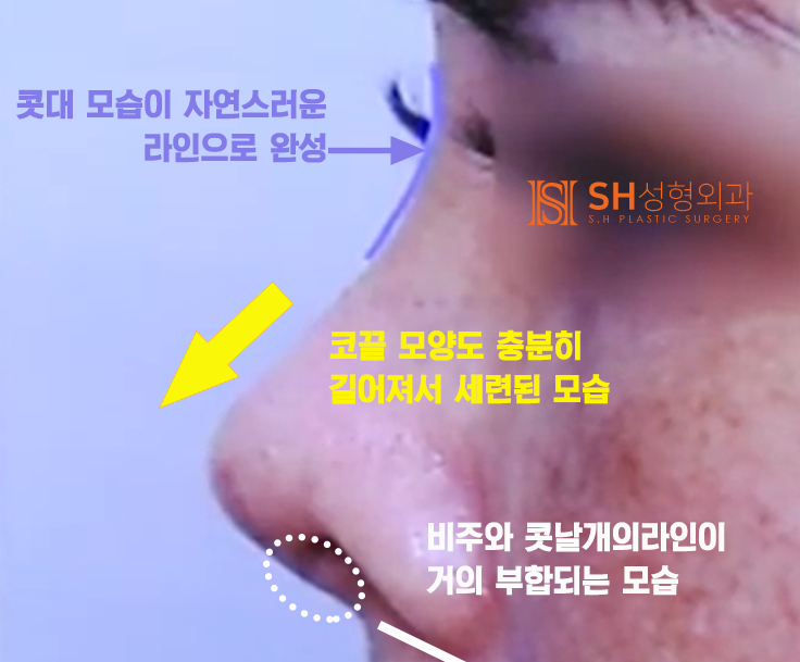 #20 Contracted Nose Revision Surgery: Can a Collapsed Nose Be Restored?
