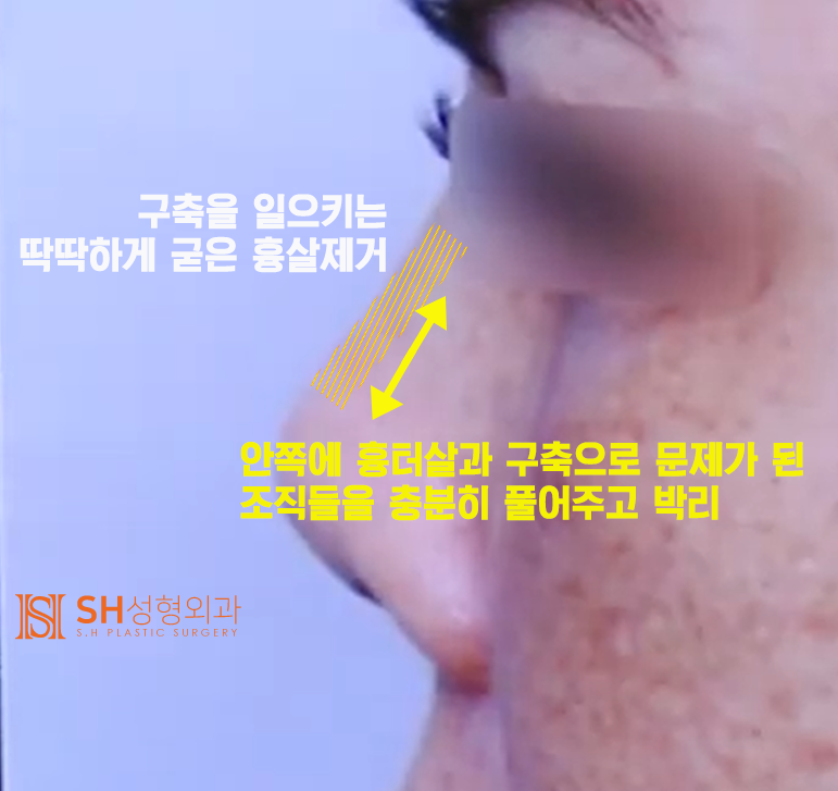 #20 Contracted Nose Revision Surgery: Can a Collapsed Nose Be Restored? 사진 6