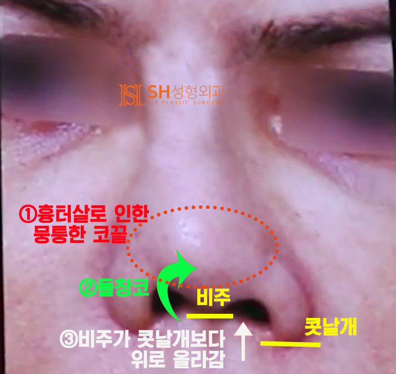 #20 Contracted Nose Revision Surgery: Can a Collapsed Nose Be Restored? 사진 3