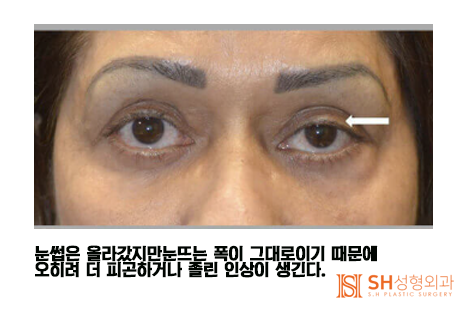 #21 Forehead Lift Review: Why Do Some People Not See Results? Feat. Self-Diagnosis Method for Forehead Lift