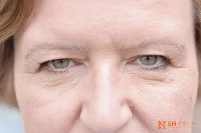 #21 Forehead Lift Review: Why Do Some People Not See Results? Feat. Self-Diagnosis Method for Forehead Lift