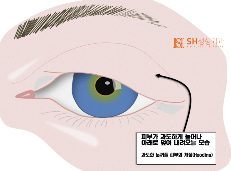 #21 Forehead Lift Review: Why Do Some People Not See Results? Feat. Self-Diagnosis Method for Forehead Lift 사진 4