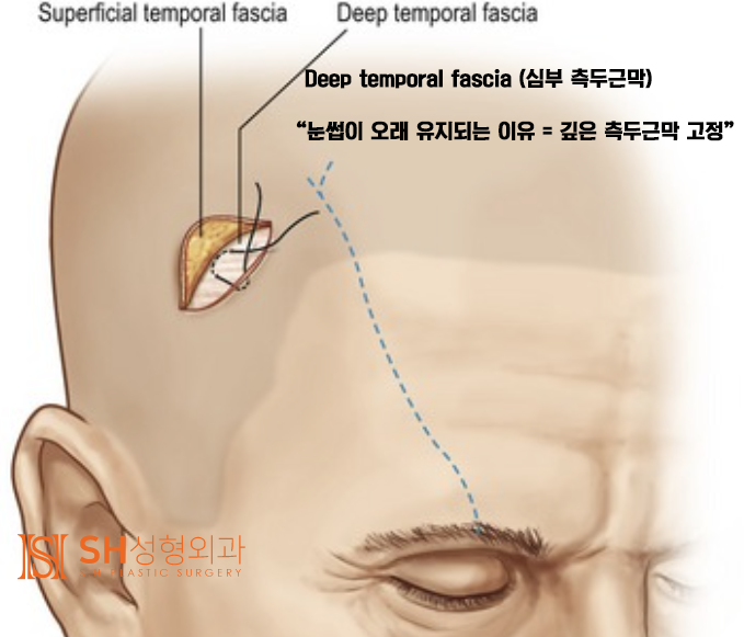 #21 Forehead Lift Review: Why Do Some People Not See Results? Feat. Self-Diagnosis Method for Forehead Lift 사진 5