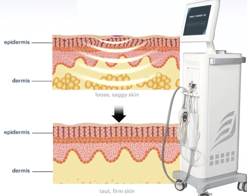 #23 Ultherapy vs. Oligio – 'Lifting devices truly make a difference when you know them well.'