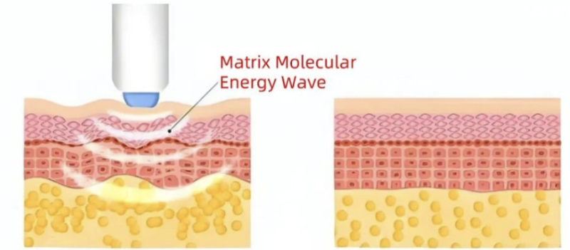 #23 Ultherapy vs. Oligio – 'Lifting devices truly make a difference when you know them well.' 사진 2