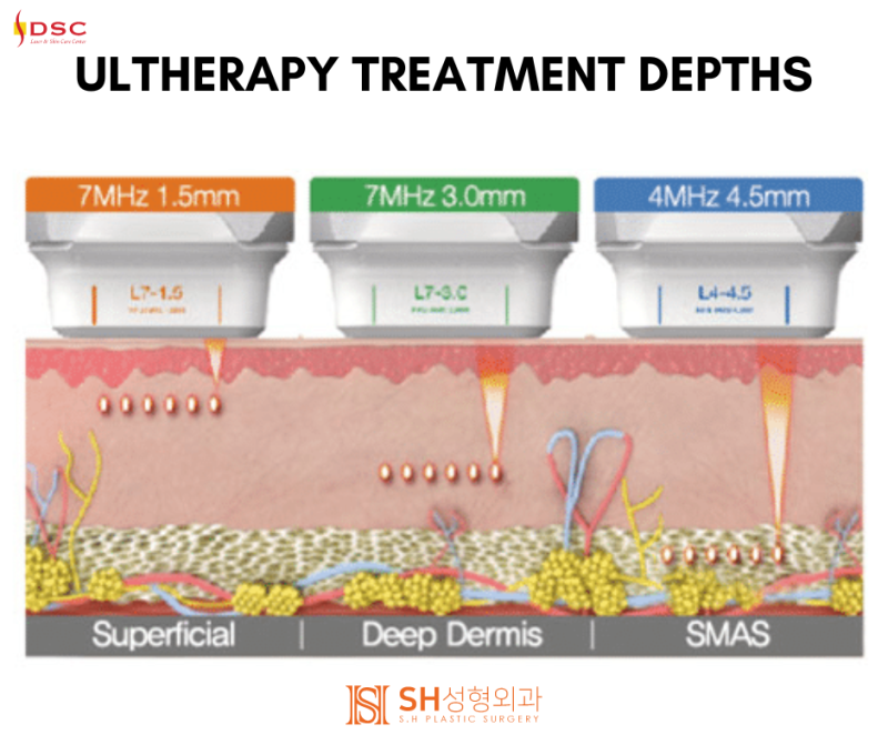 #23 Ultherapy vs. Oligio – 'Lifting devices truly make a difference when you know them well.' 사진 3