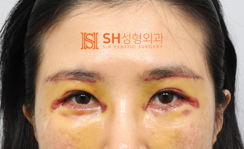 #25 Eyebrow Lift, Epicanthoplasty, Lower Blepharoplasty, and Midface Lift: A Complex Surgery Case Analysis for a 50s Fem