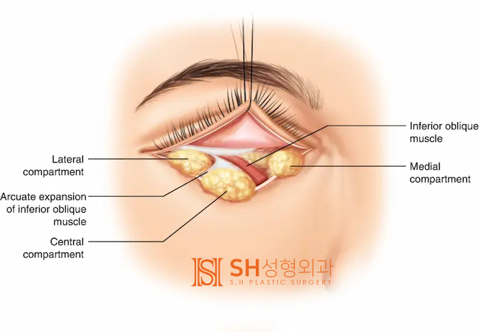 #25 Eyebrow Lift, Epicanthoplasty, Lower Blepharoplasty, and Midface Lift: A Complex Surgery Case Analysis for a 50s Fem