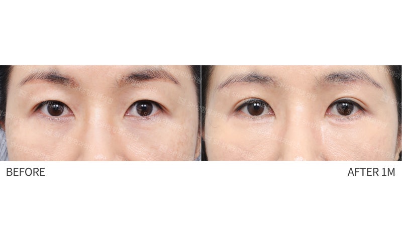 #25 Eyebrow Lift, Epicanthoplasty, Lower Blepharoplasty, and Midface Lift: A Complex Surgery Case Analysis for a 50s Female