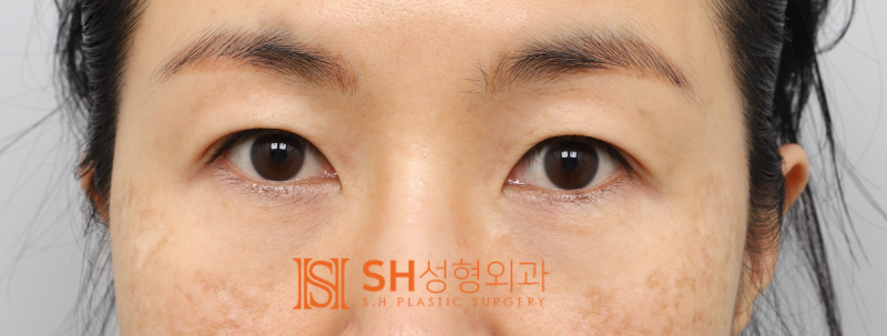 #25 Eyebrow Lift, Epicanthoplasty, Lower Blepharoplasty, and Midface Lift: A Complex Surgery Case Analysis for a 50s Fem