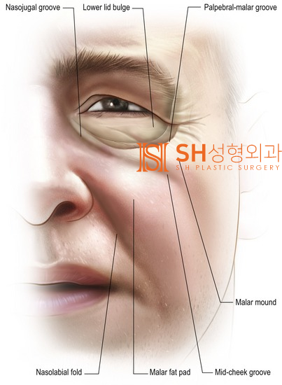 #25 Eyebrow Lift, Epicanthoplasty, Lower Blepharoplasty, and Midface Lift: A Complex Surgery Case Analysis for a 50s Fem