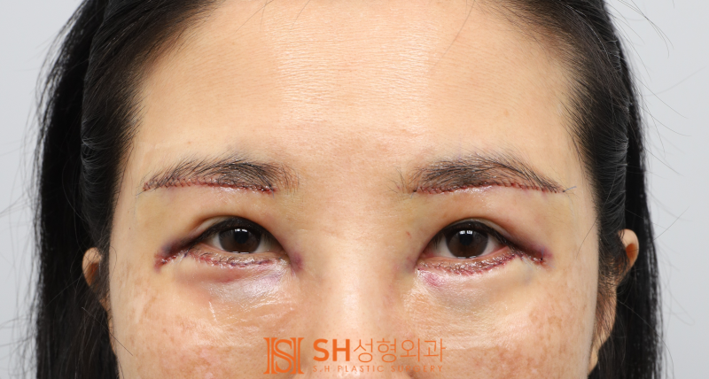 #25 Eyebrow Lift, Epicanthoplasty, Lower Blepharoplasty, and Midface Lift: A Complex Surgery Case Analysis for a 50s Fem