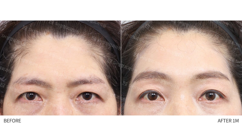#26 Why Double Eyelid Revision Wasn't the Answer: A Case of Endotine Endoscopic Forehead Lift in a 50s Patient 사진 6