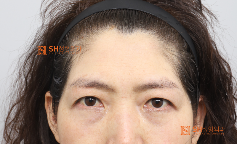 #26 Why Double Eyelid Revision Wasn't the Answer: A Case of Endotine Endoscopic Forehead Lift in a 50s Patient 사진 2