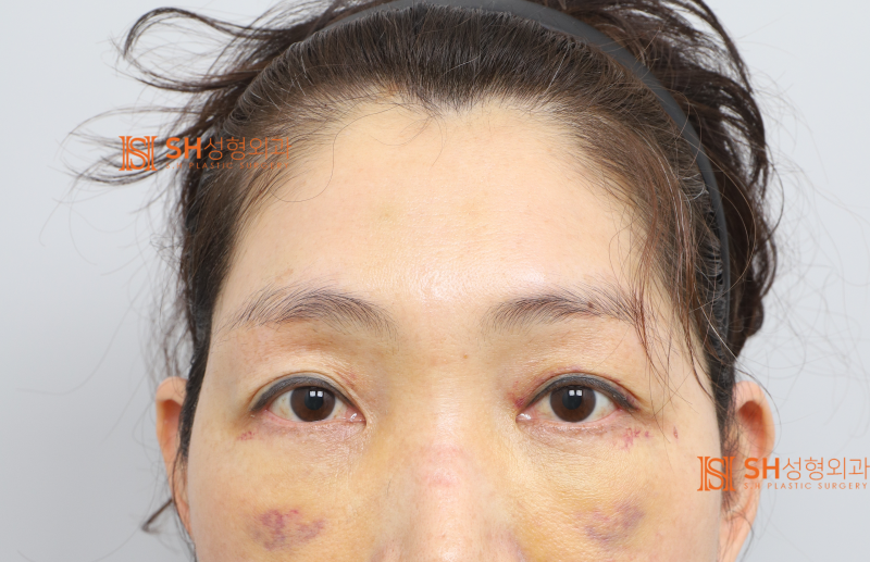 #26 Why Double Eyelid Revision Wasn't the Answer: A Case of Endotine Endoscopic Forehead Lift in a 50s Patient 사진 3