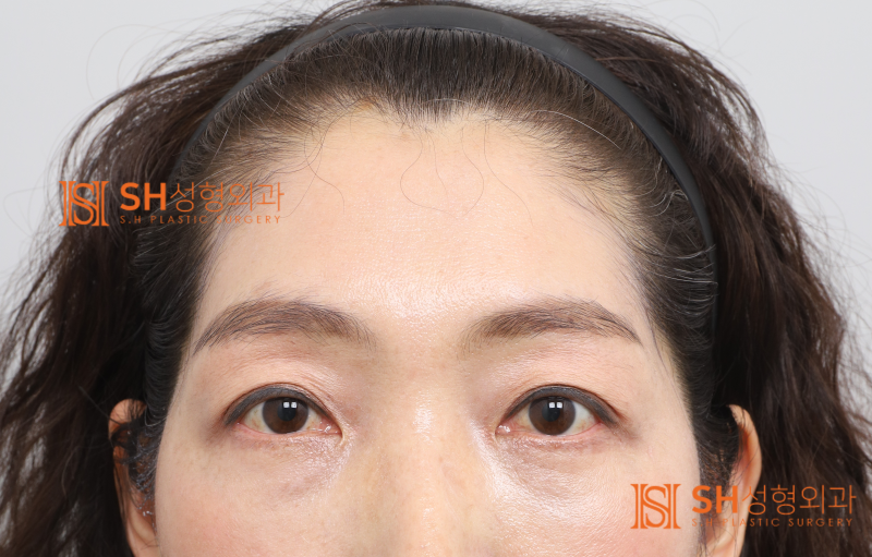 #26 Why Double Eyelid Revision Wasn't the Answer: A Case of Endotine Endoscopic Forehead Lift in a 50s Patient 사진 4