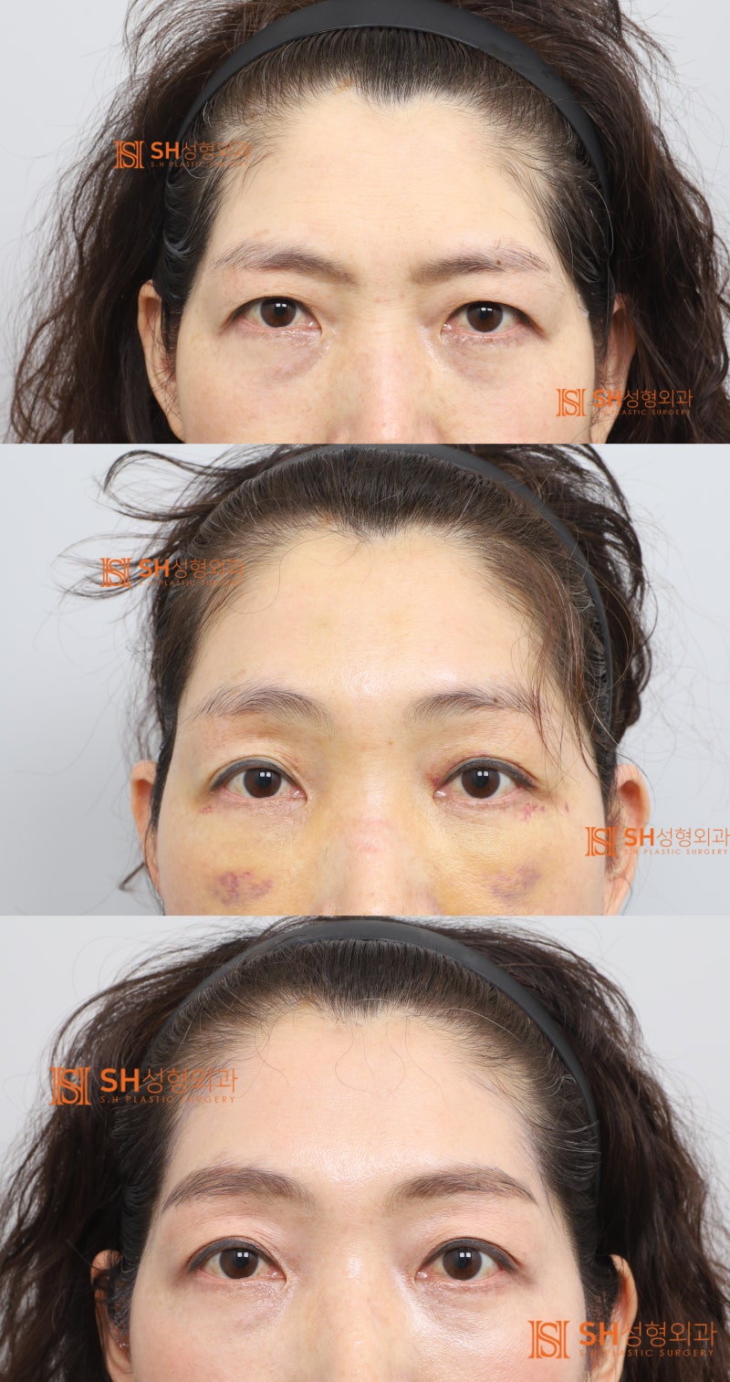 #26 Why Double Eyelid Revision Wasn't the Answer: A Case of Endotine Endoscopic Forehead Lift in a 50s Patient 사진 5