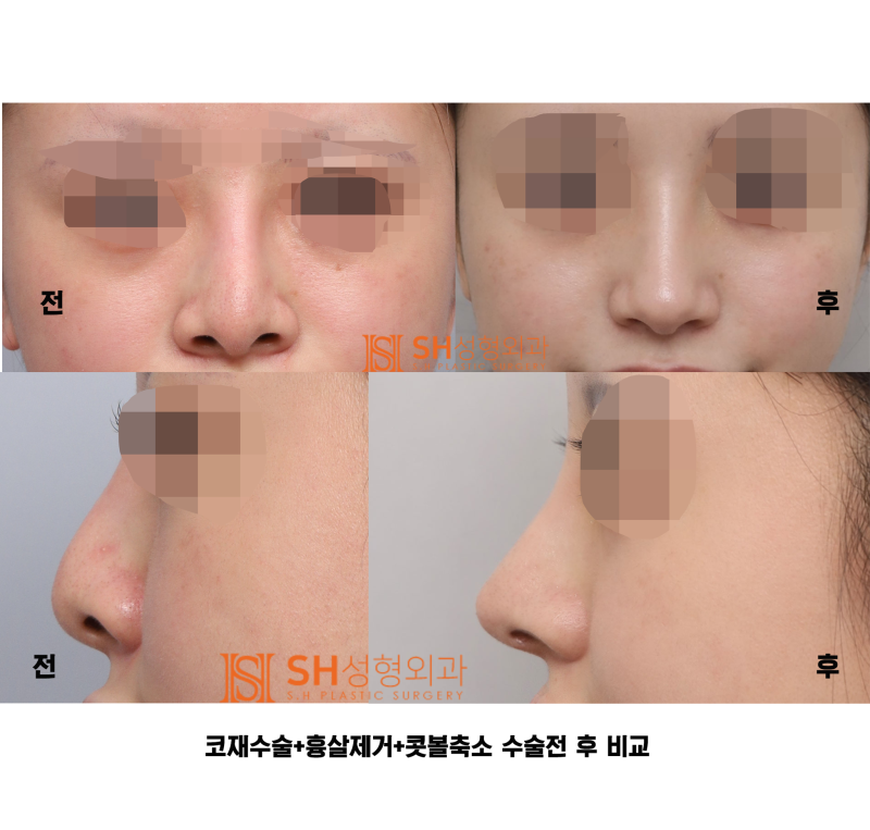 #27 Revision Rhinoplasty Review: What Has Changed? Understanding Support Structures for Tip Surgery, Implant Replacement