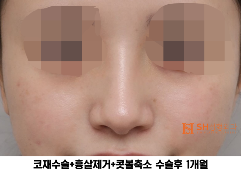 #27 Revision Rhinoplasty Review: What Has Changed? Understanding Support Structures for Tip Surgery, Implant Replacement