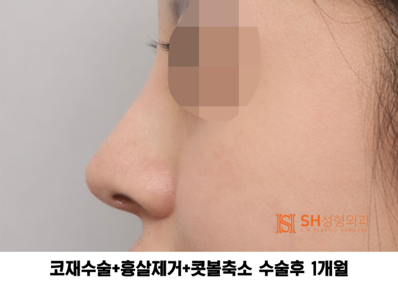 #27 Revision Rhinoplasty Review: What Has Changed? Understanding Support Structures for Tip Surgery, Implant Replacement