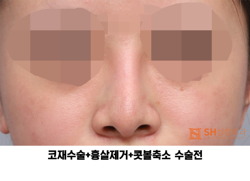 #27 Revision Rhinoplasty Review: What Has Changed? Understanding Support Structures for Tip Surgery, Implant Replacement
