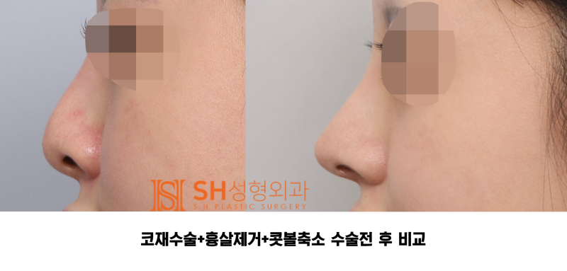 #27 Revision Rhinoplasty Review: What Has Changed? Understanding Support Structures for Tip Surgery, Implant Replacement, and Scar Tissue Removal