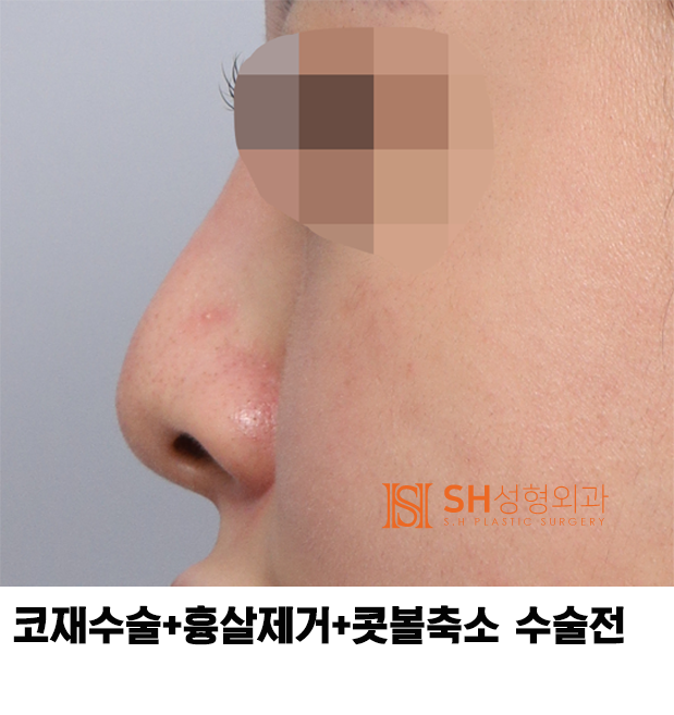#27 Revision Rhinoplasty Review: What Has Changed? Understanding Support Structures for Tip Surgery, Implant Replacement