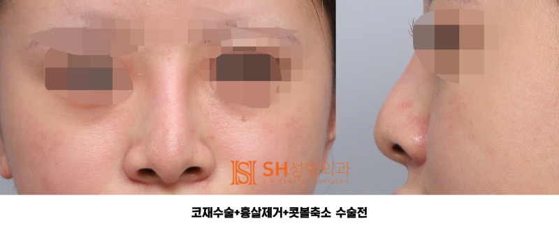 #27 Revision Rhinoplasty Review: What Has Changed? Understanding Support Structures for Tip Surgery, Implant Replacement