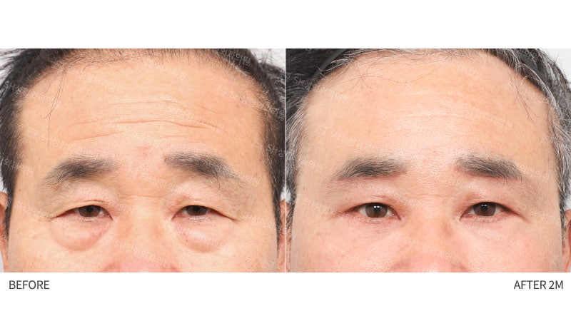 #28 60s Male Eye Surgery, Reasons for Tearing_ Middle-Aged Male Complex Lifting Case