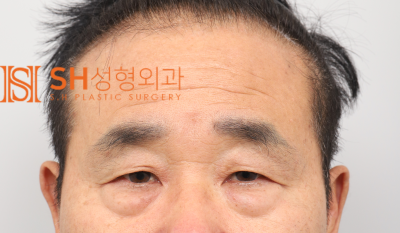 #28 60s Male Eye Surgery, Reasons for Tearing_ Middle-Aged Male Complex Lifting Case
