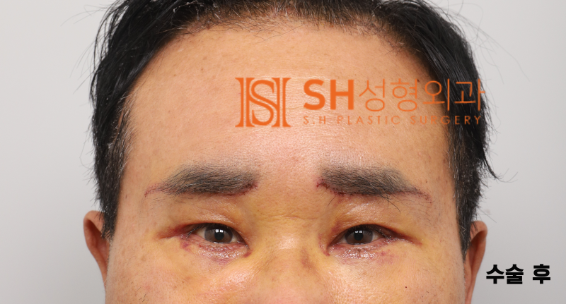 #28 60s Male Eye Surgery, Reasons for Tearing_ Middle-Aged Male Complex Lifting Case 사진 4