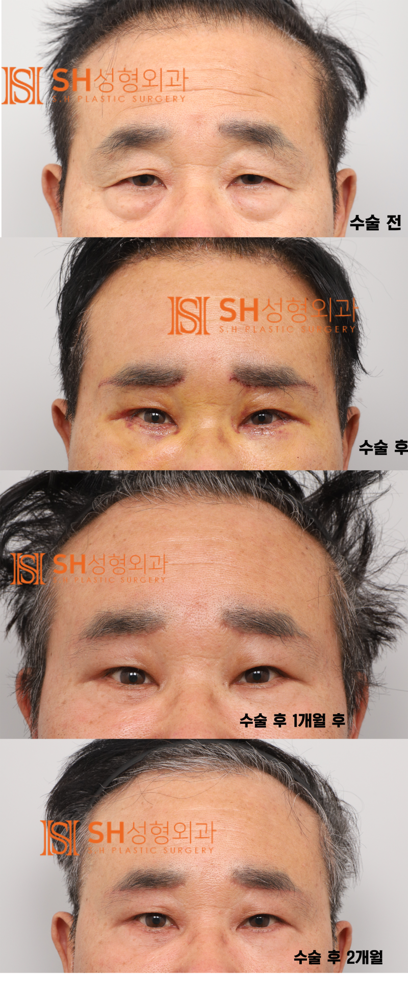 #28 60s Male Eye Surgery, Reasons for Tearing_ Middle-Aged Male Complex Lifting Case 사진 9