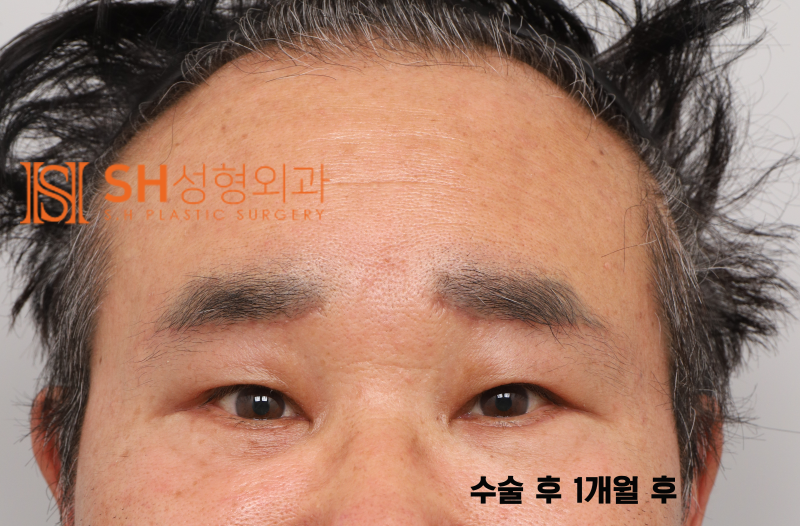 #28 60s Male Eye Surgery, Reasons for Tearing_ Middle-Aged Male Complex Lifting Case 사진 5