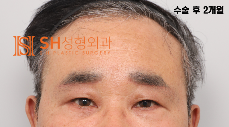 #28 60s Male Eye Surgery, Reasons for Tearing_ Middle-Aged Male Complex Lifting Case 사진 7