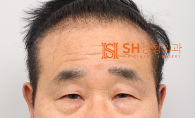 #28 60s Male Eye Surgery, Reasons for Tearing_ Middle-Aged Male Complex Lifting Case 사진 2