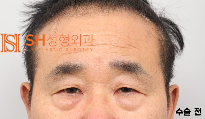 #28 60s Male Eye Surgery, Reasons for Tearing_ Middle-Aged Male Complex Lifting Case 사진 3