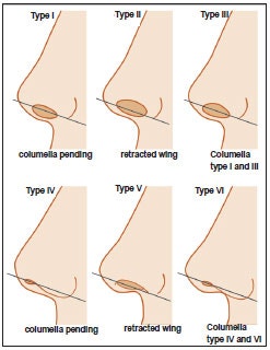 #29 Alar Reduction vs. Long Nose Surgery, How to Decide on Tip Plasty? _ Tip Plasty Review, Recovery at SH Plastic Surge