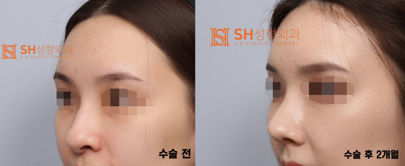 #29 Alar Reduction vs. Long Nose Surgery, How to Decide on Tip Plasty? _ Tip Plasty Review, Recovery at SH Plastic Surge