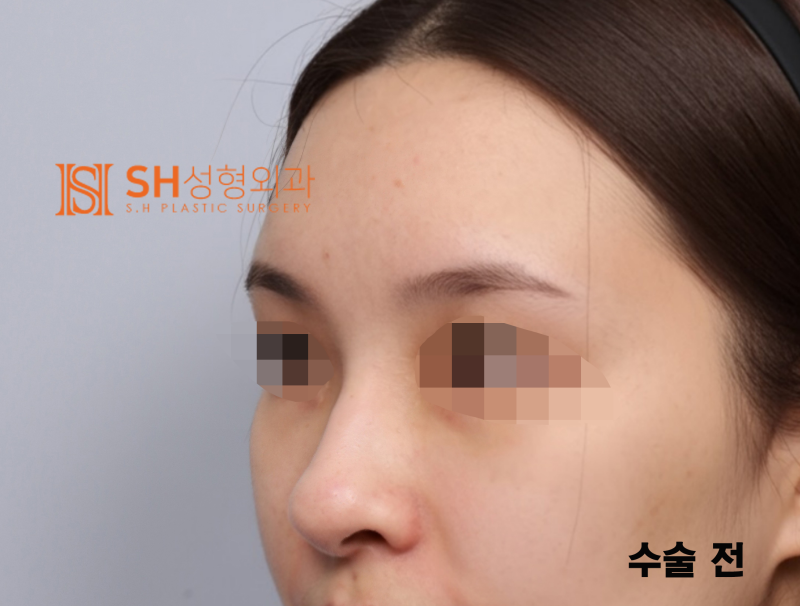 #29 Alar Reduction vs. Long Nose Surgery, How to Decide on Tip Plasty? _ Tip Plasty Review, Recovery at SH Plastic Surge
