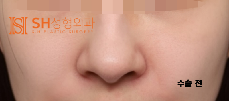 #29 Alar Reduction vs. Long Nose Surgery, How to Decide on Tip Plasty? _ Tip Plasty Review, Recovery at SH Plastic Surge