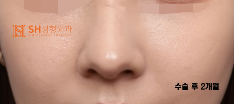 #29 Alar Reduction vs. Long Nose Surgery, How to Decide on Tip Plasty? _ Tip Plasty Review, Recovery at SH Plastic Surge
