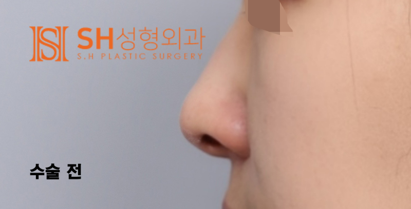 #29 Alar Reduction vs. Long Nose Surgery, How to Decide on Tip Plasty? _ Tip Plasty Review, Recovery at SH Plastic Surge