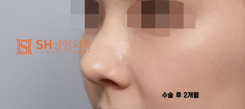 #29 Alar Reduction vs. Long Nose Surgery, How to Decide on Tip Plasty? _ Tip Plasty Review, Recovery at SH Plastic Surge