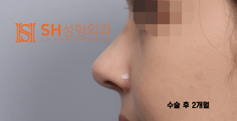#29 Alar Reduction vs. Long Nose Surgery, How to Decide on Tip Plasty? _ Tip Plasty Review, Recovery at SH Plastic Surgery