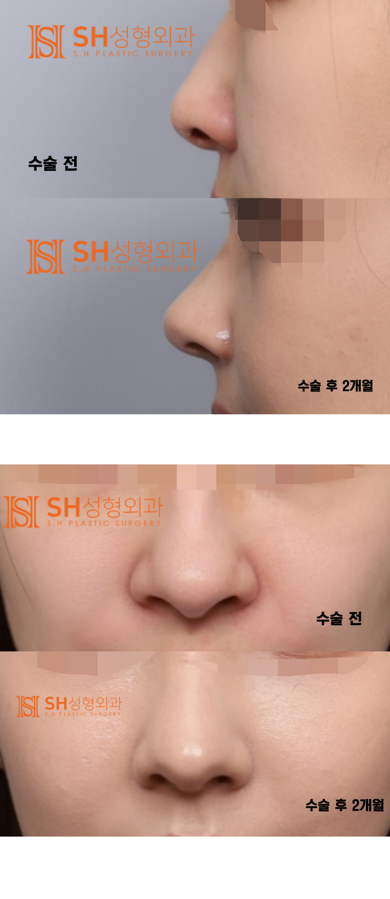 #29 Alar Reduction vs. Long Nose Surgery, How to Decide on Tip Plasty? _ Tip Plasty Review, Recovery at SH Plastic Surge